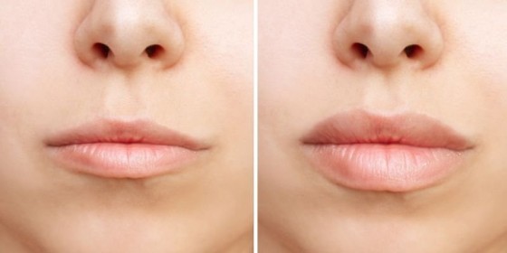 Lip Flip: Before and After Greally