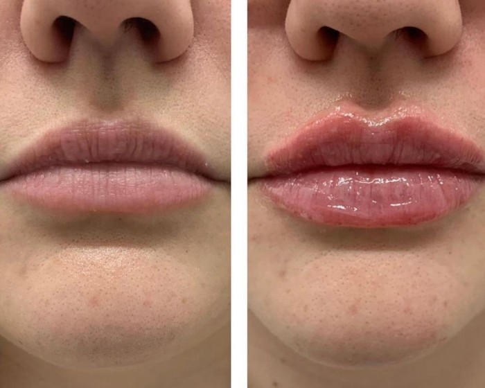 Lip Flip: Before and After Greally